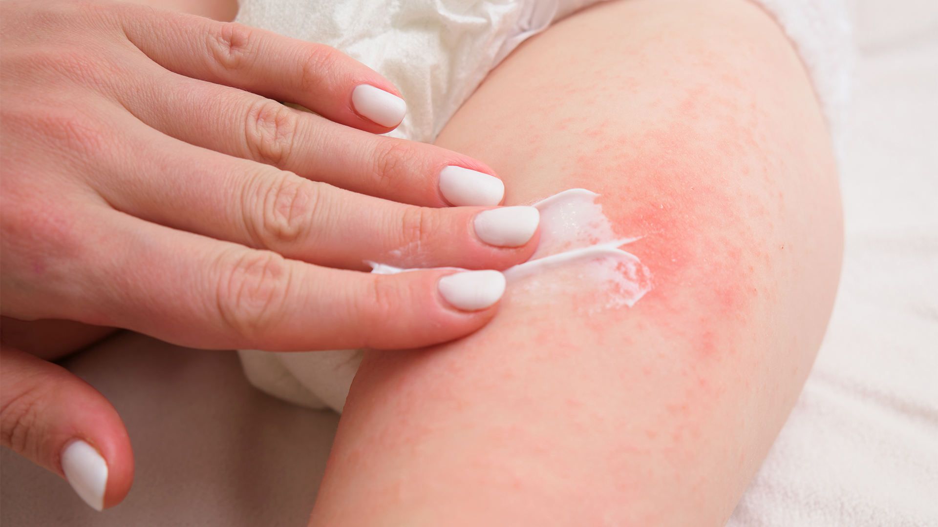 Mamá cuida la piel sensible de su bebé aplicando crema suavemente.